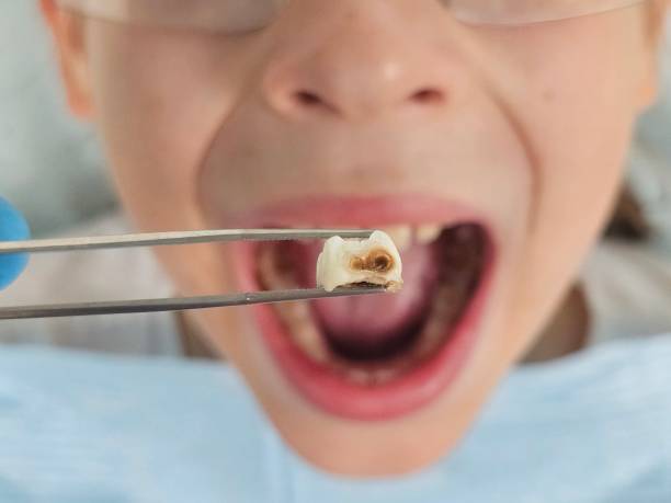 Best Walk-In Emergency Dental Services in Fairmount, IN